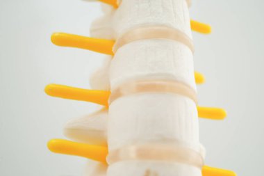 Omurga ve kemik, bel kemiği yerinden oynamış disk parçası, ortopedi bölümünde tedavi için model..