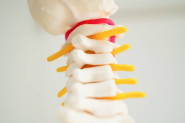 Omurga ve kemik, bel kemiği yerinden oynamış disk parçası, ortopedi bölümünde tedavi için model..