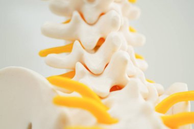 Omurga ve kemik, bel kemiği yerinden oynamış disk parçası, ortopedi bölümünde tedavi için model..