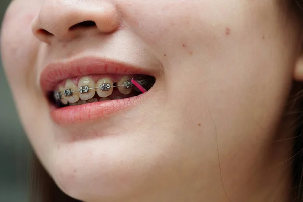 Braces Teenage Girl Mouth Treat Beauty Increase Confidence Good Personality — Photo