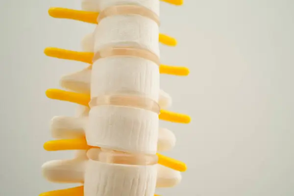 Spinal Nerve Bone Lumbar Spine Displaced Herniated Disc Fragment Model Stock Image