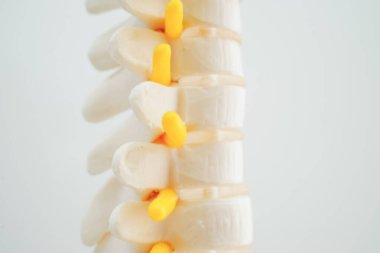 Omurga ve kemik, bel kemiği yerinden oynamış disk parçası, ortopedi bölümünde tedavi için model..