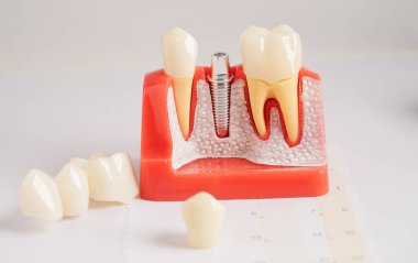 Diş implantı, çeneye yapay diş kökleri, diş tedavisinin kök kanalı, diş eti hastalığı, diş hekimliği üzerine çalışan dişçi modeli.