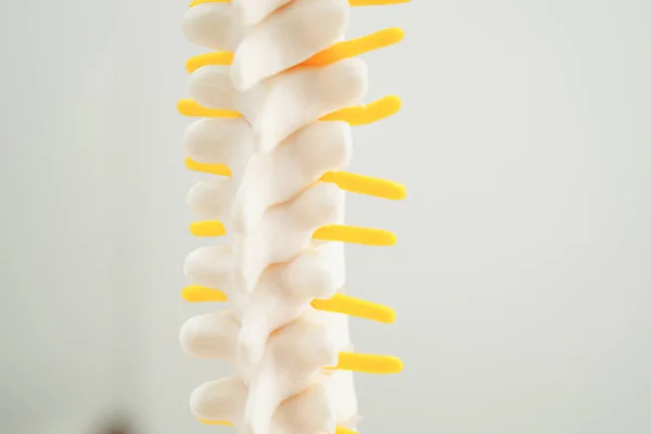 Spinal nerve and bone, Lumbar spine displaced herniated disc fragment, Model for treatment medical in the orthopedic department.