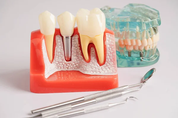 Diş implantı, çeneye yapay diş kökleri, diş tedavisinin kök kanalı, diş eti hastalığı, diş hekimliği üzerine çalışan dişçi modeli.
