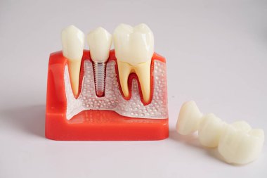Diş implantı, çeneye yapay diş kökleri, diş tedavisinin kök kanalı, diş eti hastalığı, diş hekimliği üzerine çalışan dişçi modeli.