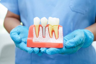 Doktor diş implantı, çeneye yapay diş kökleri, diş tedavisinin kök kanalı, diş eti hastalığı, diş hekimliği üzerine çalışan dişçi modeli.