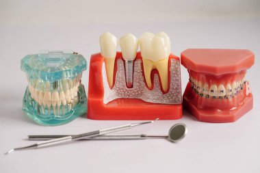 Diş hekimi ekipmanları, diş aletleri, diş sağlığı uzmanlarının diş tedavisi için kullandığı araçlar. 
