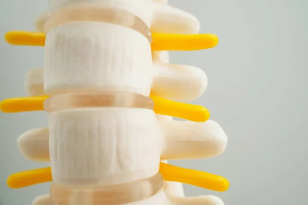 Spinale Zenuw Bot Lumbar Wervelkolom Verplaatst Hernia Schijffragment Model Voor Rechtenvrije Stockafbeeldingen