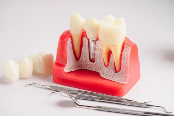 Implante Dental Raíces Dentales Artificiales Mandíbula Conducto Radicular Del Tratamiento —  Fotos de Stock