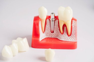 Diş implantı, çeneye yapay diş kökleri, diş tedavisinin kök kanalı, diş eti hastalığı, diş hekimliği üzerine çalışan dişçi modeli.