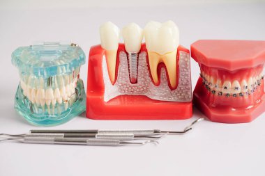 Diş implantı, çeneye yapay diş kökleri, diş tedavisinin kök kanalı, diş eti hastalığı, diş hekimliği üzerine çalışan dişçi modeli.