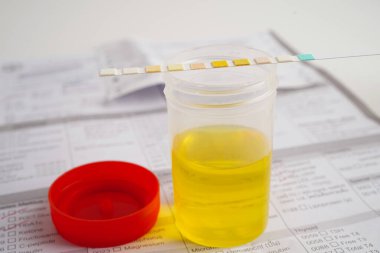 İdrar tahlili, reaksiyonlu idrar kabı. PH kağıt testi ve karşılaştırma tablosu laboratuvarda..