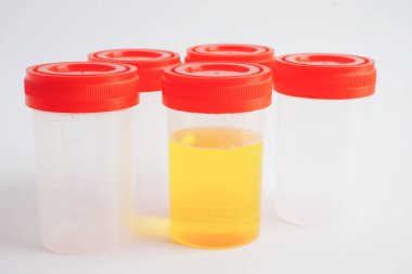 İdrar tahlili, laboratuarda sağlık kontrolü için idrar kabı..