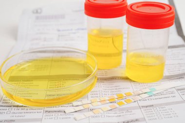 İdrar tahlili, reaksiyonlu idrar kabı. PH kağıt testi ve karşılaştırma tablosu laboratuvarda..