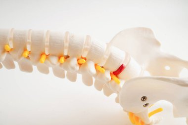 Omurga ve kemik, bel kemiği yerinden oynamış disk parçası, ortopedi bölümünde tedavi için model..