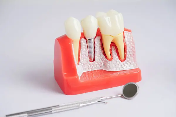 stock image Dental implant, artificial tooth roots into jaw, root canal of dental treatment, gum disease, teeth model for dentist studying about dentistry.