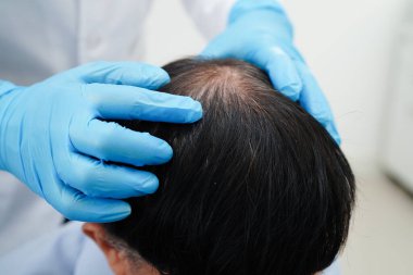 Doktor cesur bir kafa, saç dökülmesi sağlık problemi.