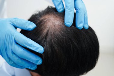 Doktor cesur bir kafa, saç dökülmesi sağlık problemi.