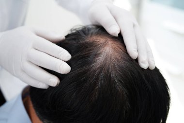 Doktor cesur bir kafa, saç dökülmesi sağlık problemi.