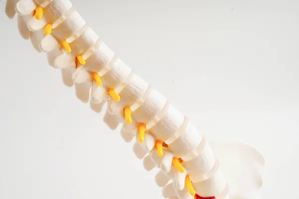 脊柱神经和骨骼 腰椎移位椎间盘突出部分 骨科治疗模型 — 图库照片
