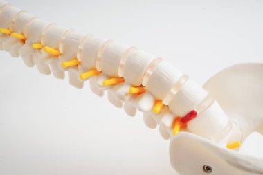 Omurga ve kemik, bel kemiği yerinden oynamış disk parçası, ortopedi bölümünde tedavi için model..