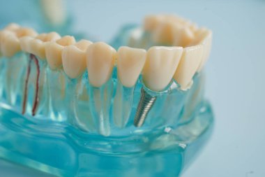 Diş implantı, çeneye yapay diş kökleri, diş tedavisinin kök kanalı, diş eti hastalığı, diş hekimliği üzerine çalışan dişçi modeli.