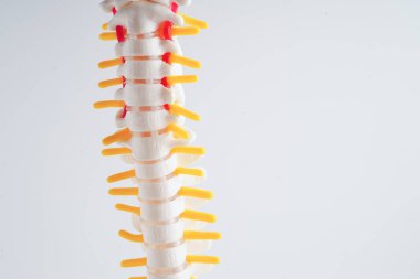 Omurga ve kemik, bel kemiği yerinden oynamış disk parçası, ortopedi bölümünde tedavi için model..