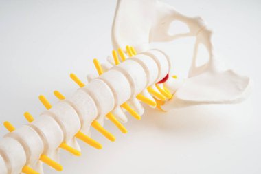 Omurga ve kemik, bel kemiği yerinden oynamış disk parçası, ortopedi bölümünde tedavi için model..