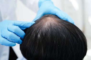 Doktor cesur bir kafa, saç dökülmesi sağlık problemi.