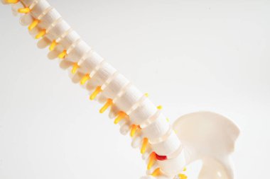 Omurga ve kemik, bel kemiği yerinden oynamış disk parçası, ortopedi bölümünde tedavi için model..