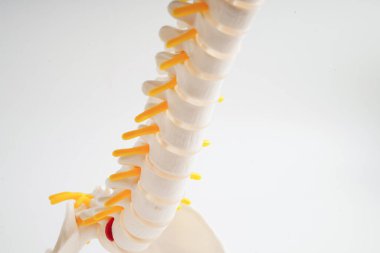 Omurga ve kemik, bel kemiği yerinden oynamış disk parçası, ortopedi bölümünde tedavi için model..
