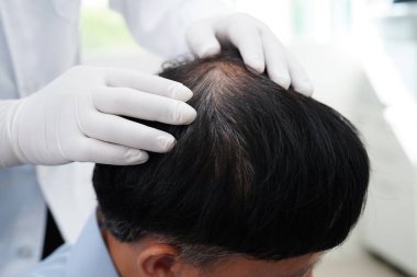 Doktor cesur bir kafa, saç dökülmesi sağlık problemi.