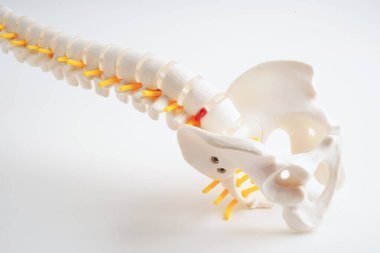 Omurga ve kemik, bel kemiği yerinden oynamış disk parçası, ortopedi bölümünde tedavi için model..