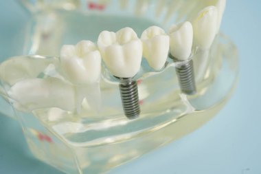 Diş implantı, çeneye yapay diş kökleri, diş tedavisinin kök kanalı, diş eti hastalığı, diş hekimliği üzerine çalışan dişçi modeli.