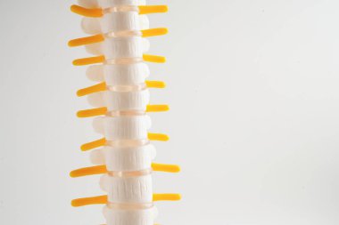 Omurga ve kemik, bel kemiği yerinden oynamış disk parçası, ortopedi bölümünde tedavi için model..