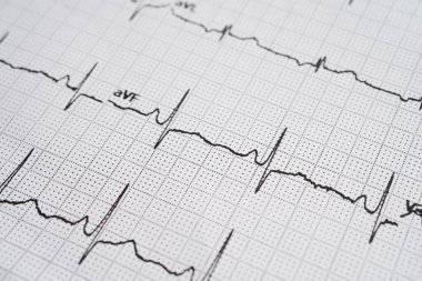 Elektrokardiyogram (EKG), kalp dalgası, kalp krizi, kardiyogram raporu.