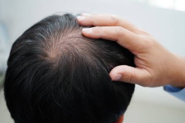 Kel kafalı adam, saç dökülmesi tedavisi sorunu.