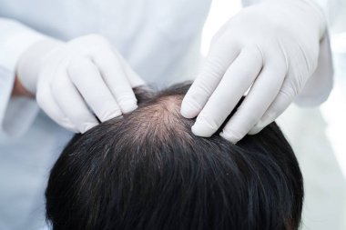 Doktor cesur bir kafa, saç dökülmesi sağlık problemi.