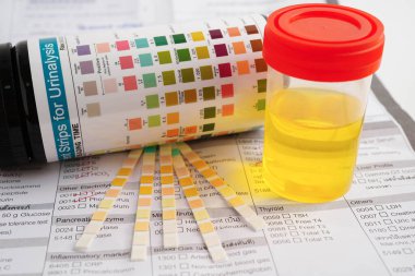 İdrar tahlili, reaksiyonlu idrar kabı. PH kağıt testi ve karşılaştırma tablosu laboratuvarda..