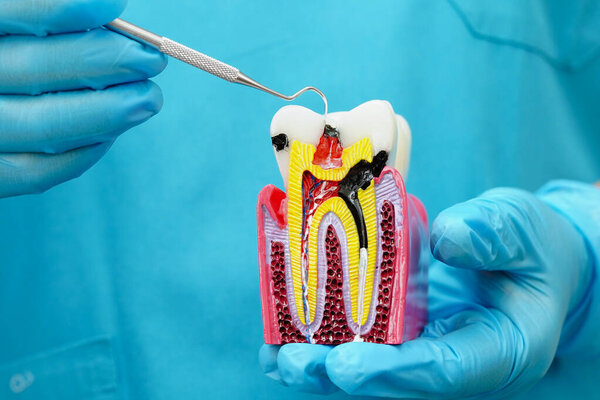 Dentist holding dental implant, artificial tooth roots into jaw, root canal of dental treatment, gum disease, teeth model for dentist.