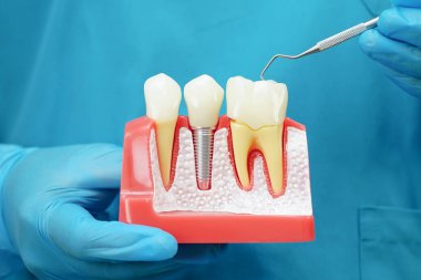 Diş implantı tutan diş hekimi, çeneye yapay diş kökleri, diş tedavisi kanal tedavisi, diş eti hastalığı, dişçi için diş modeli.
