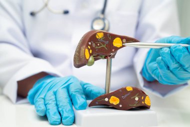 Dünya Hepatit Günü 'nde siroz, karaciğer kanseri, yağlı karaciğer, karaciğer anatomisi olan Asyalı doktor..