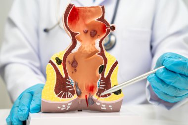 Hastanede rektum ve hemoroit insan anatomisi modeli olan Asyalı bir doktor vasküler yapısında iltihaplanma var..