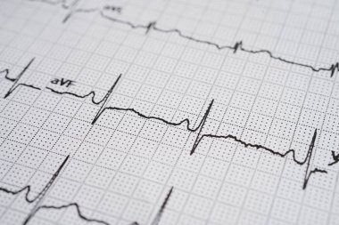 Elektrokardiyogram (EKG), kalp dalgası, kalp krizi, kardiyogram raporu.