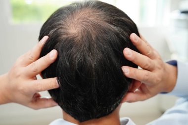 Kel kafalı adam, saç dökülmesi tedavisi sorunu.