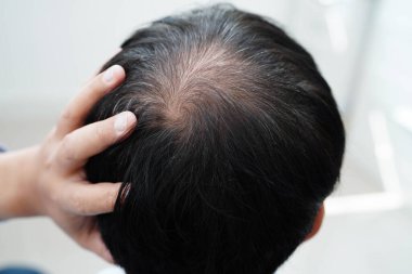 Kel kafalı adam, saç dökülmesi tedavisi sorunu.