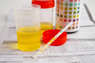 İdrar tahlili, reaksiyonlu idrar kabı. PH kağıt testi ve karşılaştırma tablosu laboratuvarda..