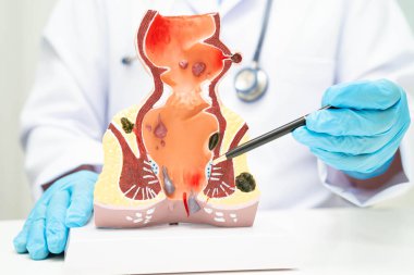 Hastanede rektum ve hemoroit insan anatomisi modeli olan Asyalı bir doktor vasküler yapısında iltihaplanma var..