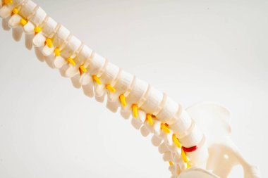 Omurga ve kemik, bel kemiği yerinden oynamış disk parçası, ortopedi bölümünde tedavi için model..